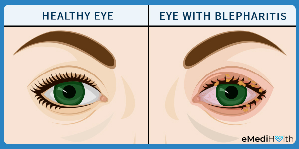 如何诊断眼睑炎?